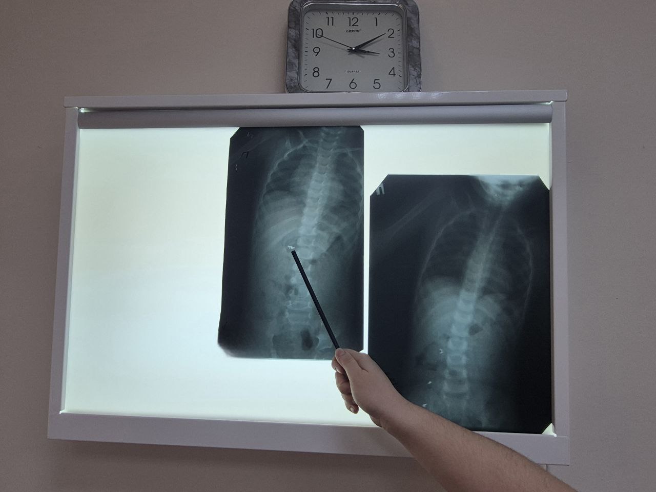 Дети проглотили застежку от цепочки и десятирублевую монету в Саратовской области